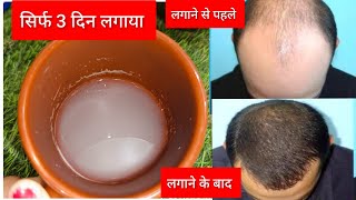 सिर्फ 3 दिन लगाया सिर पर नए बाल आ गए 😱
