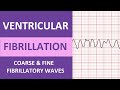 Ventricular Fibrillation Treatment and Concepts