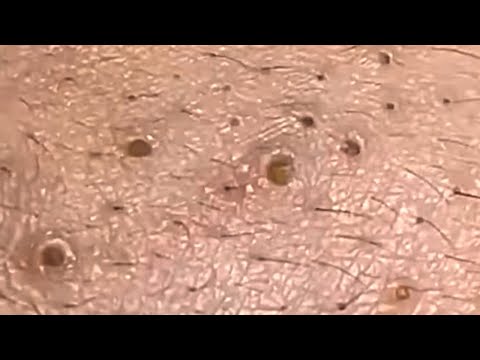 Blackheads & Whiteheads Satisfying Removal @0372