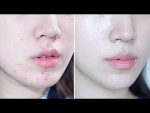 How To Get Rid Of Acne Naturally | Skin Transformation ❤ Liah Yoo