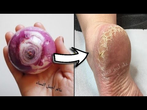 قولي وداعا لخشونة وتشققات القدمين مجربة مني شخصيا .تقشير، تنعيم ترطيب وتبييض فوري