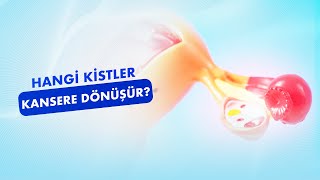 Hangi Kistler Kansere Dönüşür? Yumurtalık Kistleri ve Kanser İlişkisi