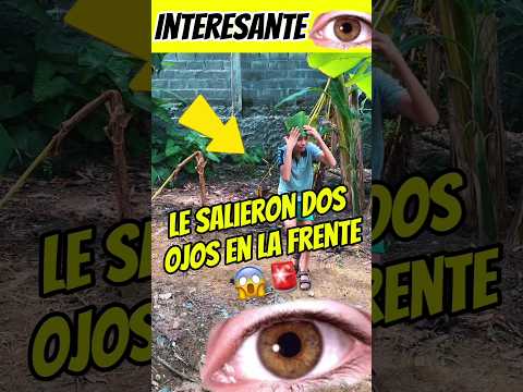 A este joven le salieron dos ojos en la frente 😰😱 Interesante Asombróso 😰😱