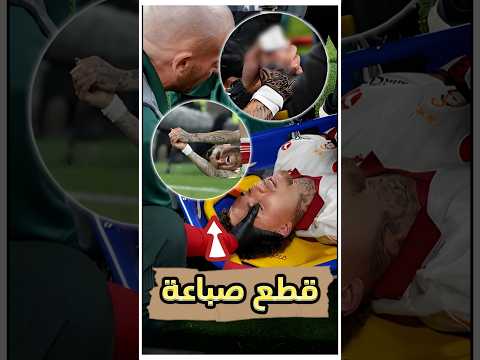 “لقطة مرعبة: إصابة انتهت بقطع صباع لاعب قدام العالم! 💔😨”