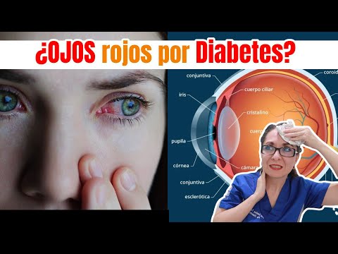 ¿OJOS Rojos por Diabetes? Qué hacer /Dra. Melissa Tejeida