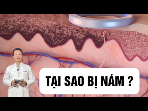 8 Nguyên Nhân Gây Nám Da – Điều Thứ 5 Ai Cũng Bất Ngờ ! | Đào Ngọc Anh Clinic