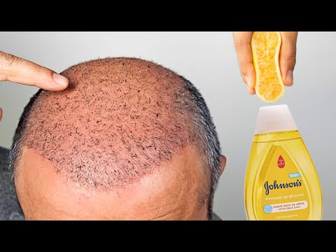 Adicione isso ao shampoo 🌱 O cabelo cresce loucamente e a calvície vai embora