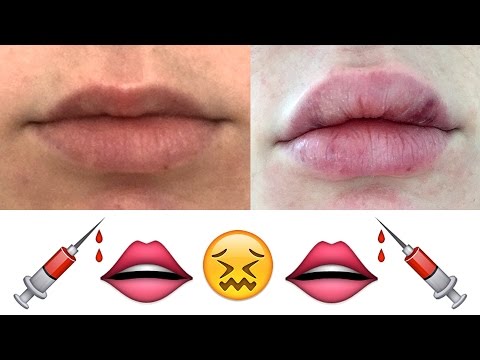 My Honest Experience With Lip Injections | Lauren Curtis