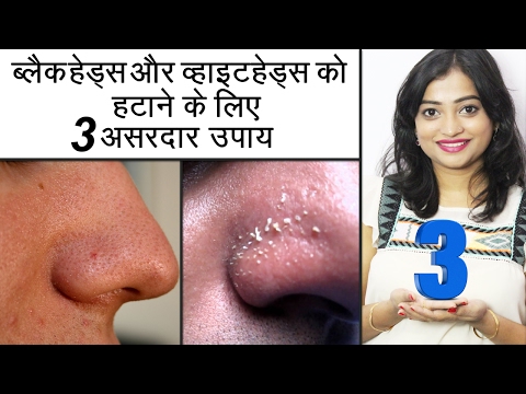 ब्लैकहेड्स और वाइटहेड्स को हटाने के लिए 3 उपाय | Home Remedies to Remove Blackheads & Whiteheads