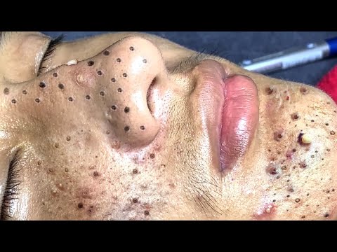 Blackhead Removal With Sac Dep Spa @100074055