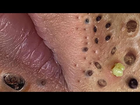 Blackhead Removal With Sac Dep Spa @100074546