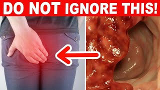 10 Early Warning Signs Of Colon Cancer You Should Never Ignore