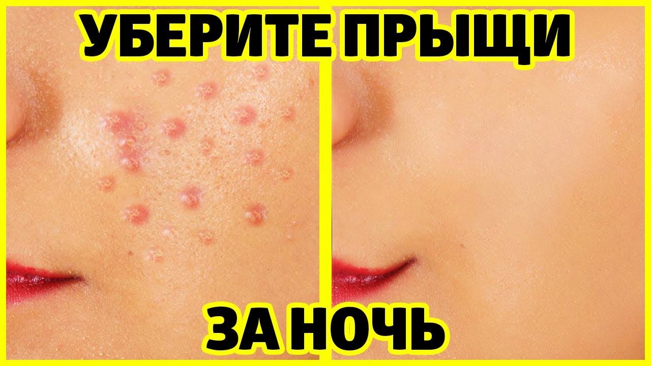 Как убрать прыщи за ночь - лучшие рабочие средства!