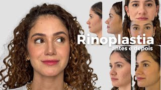 Meu nariz depois de 1 ano de rinoplastia | o que mudou?