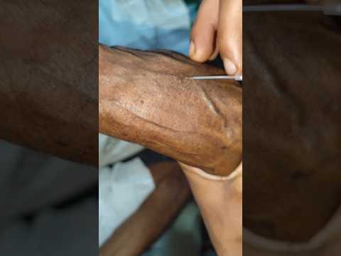 IV Cannulation Technique Procedure