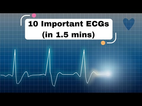 10 Important ECGs (in 1.5 mins) #cardiology #ecg #ekg