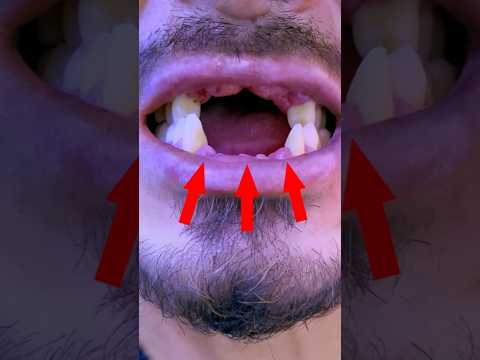 !!️ NEW TEETH!!️ So that you can be inspired. #mrdent #dentadura #sabiasque