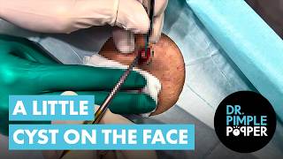 A Little Cyst on the Face