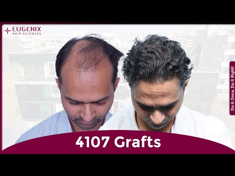 Why Research Matters: Choosing the Right Hair Transplant Clinic for a Natural Hairline