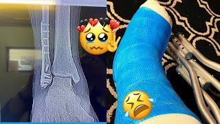 Broken Ankle Vlog/How it all went down