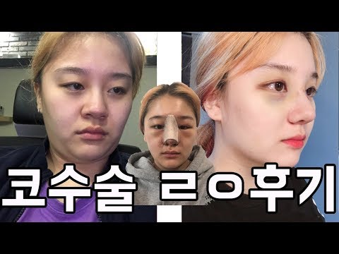 다시 태어났습니다...일주일간의 복코 수술 ㄹㅇ후기