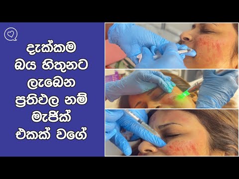 My Experience From Microneedling And PRP
