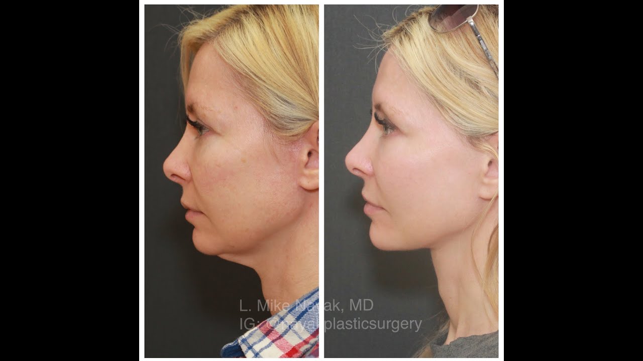 Before and after image of facial enhancement.