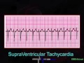 Cardiac Rhythm Characteristics and Treatments