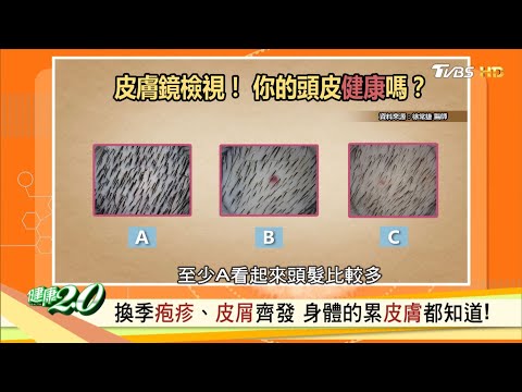 一天掉多少髮量 有問題? 未成熟掉落、超過百根是異常 健康2.0