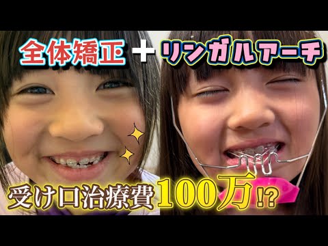 【歯科矯正】受け口治療9カ月目の経過は？全体矯正をしたらまさかの流血事件が…！？【7歳】