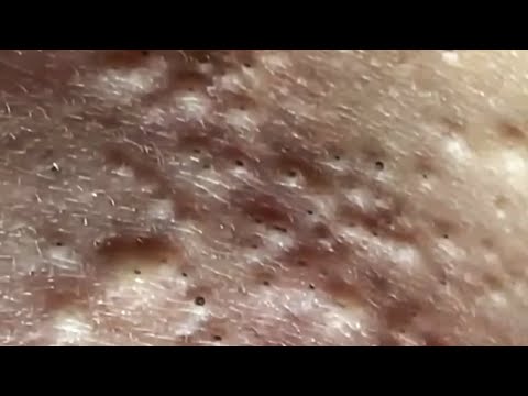 Blackheads & Whiteheads Satisfying Removal @0534