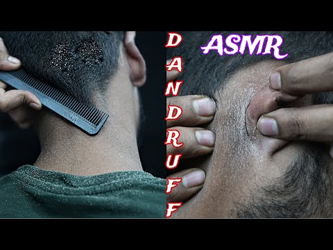 Dandruff ASMR | Huge Dandruff Removal ASMR | Dandruff Scratching ASMR | ASMR Dandruff Removal Video