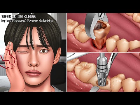 ASMR 오~랫동안 방치한 썩은치아 임플란트 식립 과정 애니메이션 | 치아미백, 충치치료, 발치 | Implant process, Cavities, Teeth Whitening