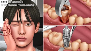 ASMR 오~랫동안 방치한 썩은치아 임플란트 식립 과정 애니메이션 | 치아미백, 충치치료, 발치 | Implant process, Cavities, Teeth Whitening