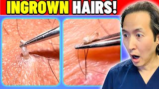 Plastic Surgeon Reacts to SATISFYING Ingrown Hair Extractions!