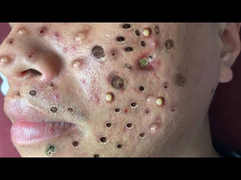 Blackhead Removal With Sac Dep Spa @100074287