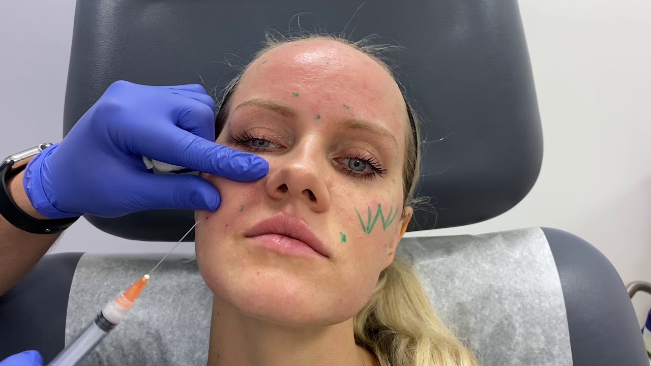Woman with markings for cosmetic procedure preparation.