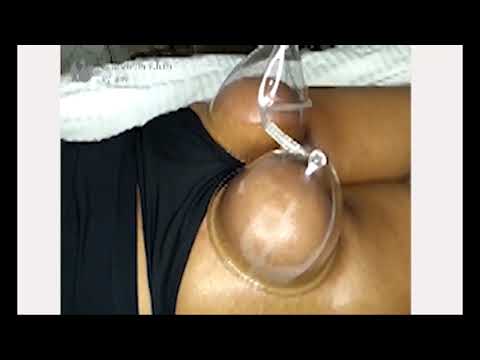 Breast enhancement vacuum therapy session in progress.