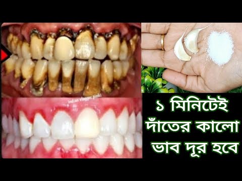 এটা লাগিয়ে দেখুন একবার দাঁত হবে মুক্তোর মতো সাদা চকচকে/আয়রন,হলুদ ভাব,ও কালো দাগ উঠে যাবে এই উপায়ে