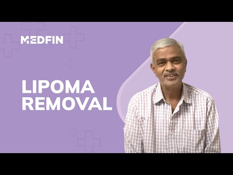 Lipoma Surgery | Hassle-free experience| Patient Talks