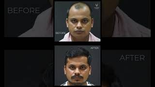 Before & After Robotic Hair Restoration | Real Patient Results | Musk Clinic