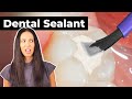 Understanding Dental Sealants