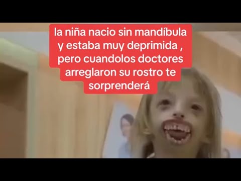 la niña nacio sin mandíbula y estaba muy deprimida , pero cuando los doctores arreglaron su rostro