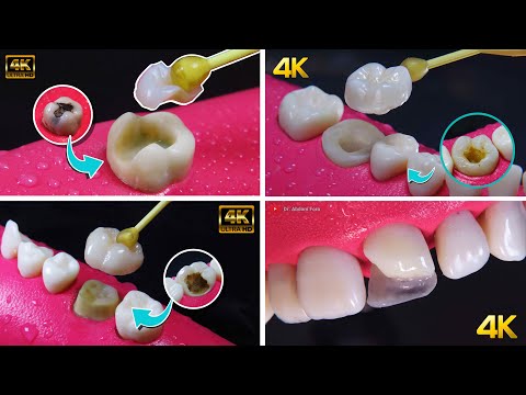 Types of dental treatments to save a tooth