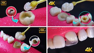 Types of dental treatments to save a tooth