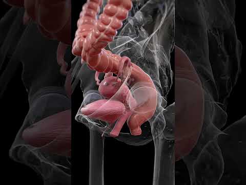 🌸 Endometriosis: Understanding the Silent Struggle 🌸 #anatomy