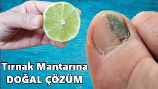 Mantarlara Veda Edin. Tırnak Mantarı İle Savaşmanın En İyi Çözümü Budur.
