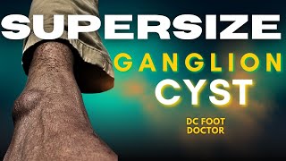 Supersize Ganglion Cyst