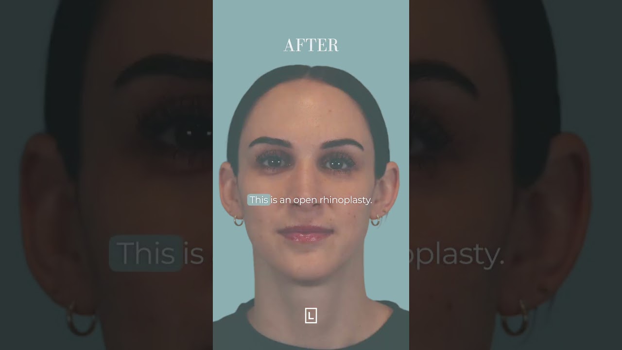 rhinoplasty journey