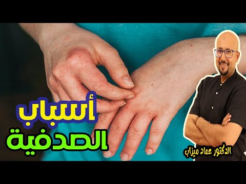 السبب الرئيسي في الإصابة بالصدفية   -   الدكتور عماد ميزاب  -